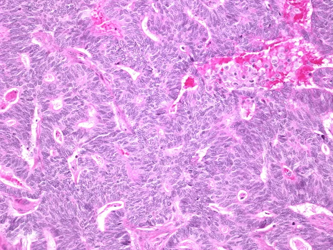 Papillary Carcinoma of Breast : Solid variant with spindling