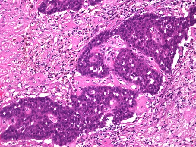 Invasive Papillary Carcinoma of Breast