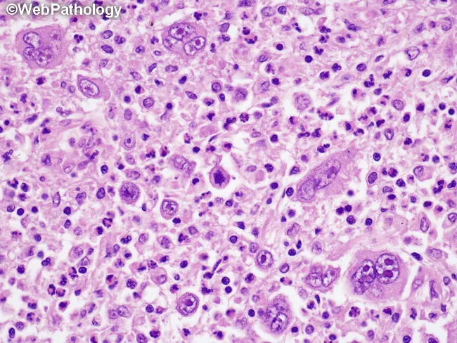Reed-Sternberg Cells