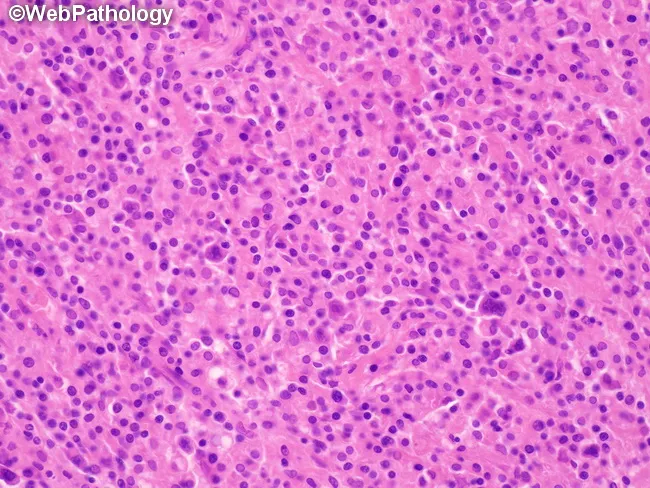 Mixed Cellularity Hodgkin Lymphoma