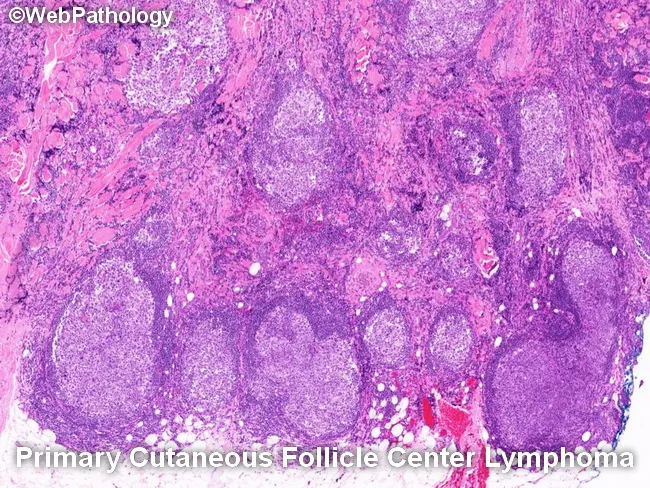 Cutaneous Follicle Center Lymphoma : Differential