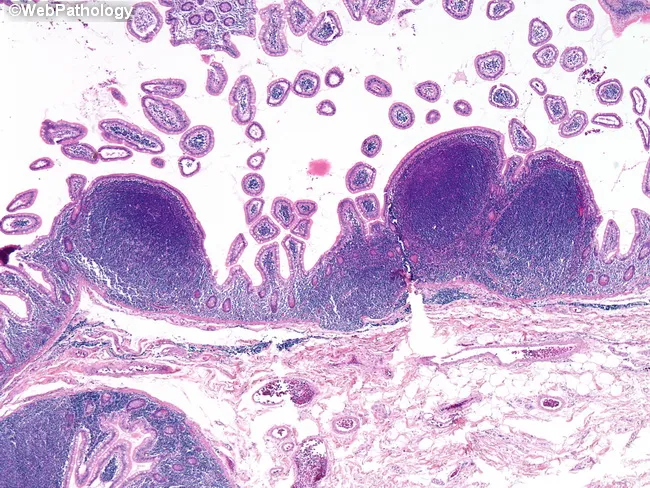 Lymphomatous Polyposis