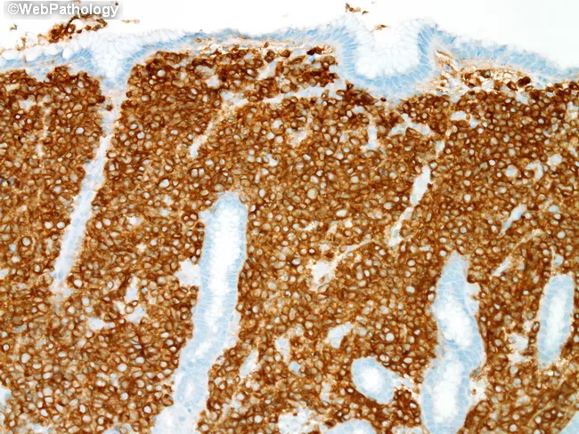 DLBCL : Stomach - CD79