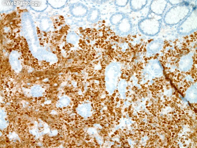 DLBCL : Stomach - BCL6