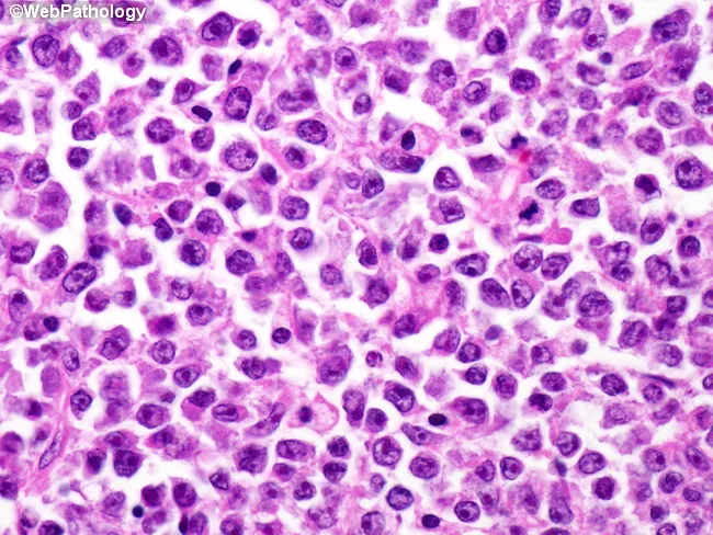 DLBCL : Spleen