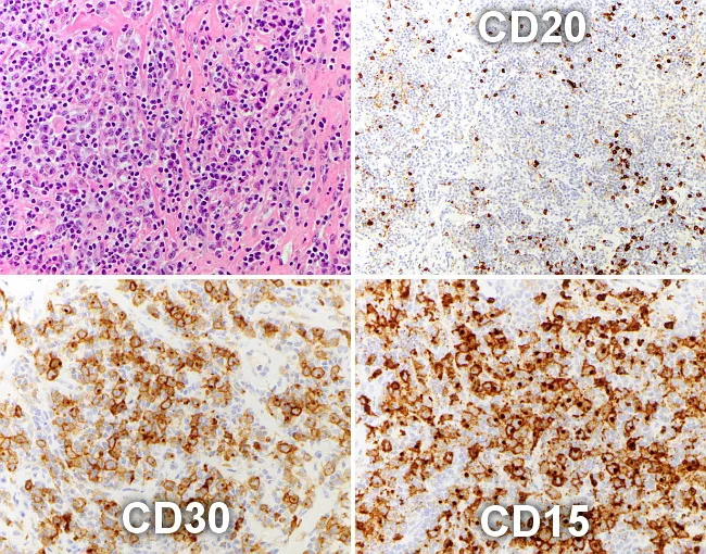 Mediastinal Grey Zone Lymphoma