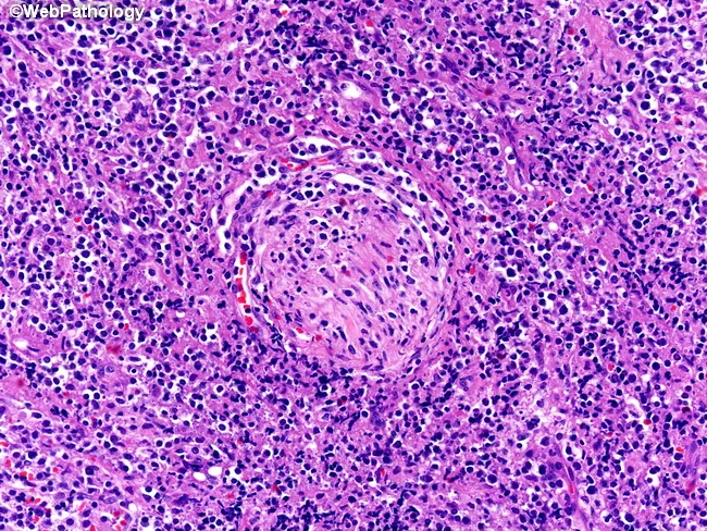 mature nk t cell lymphoma icd 10