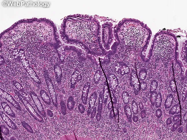 EATL & Celiac Disease