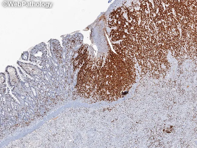 EATL - Immunophenotype : CD7