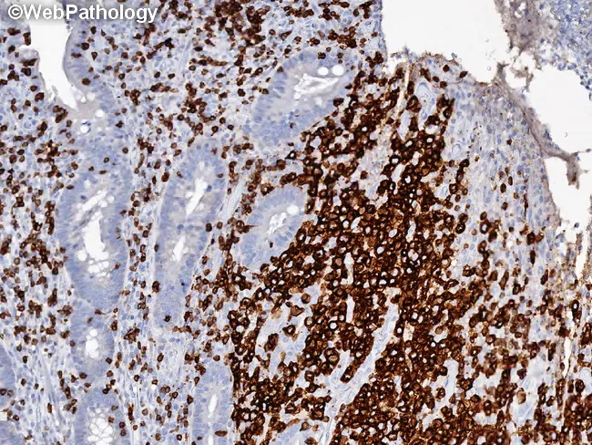 EATL - Immunophenotype : CD7