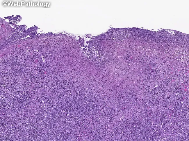 MEITL : Intro & Clinical