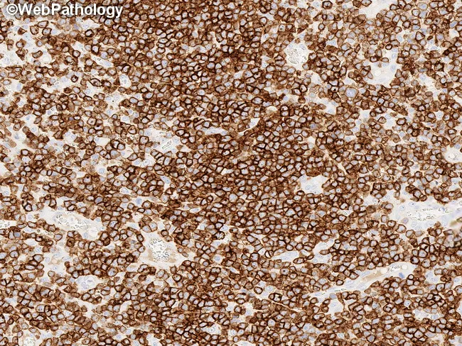 MEITL : Immunophenotype - CD8
