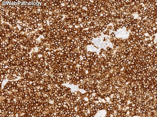 MEITL : Immunophenotype - CD56