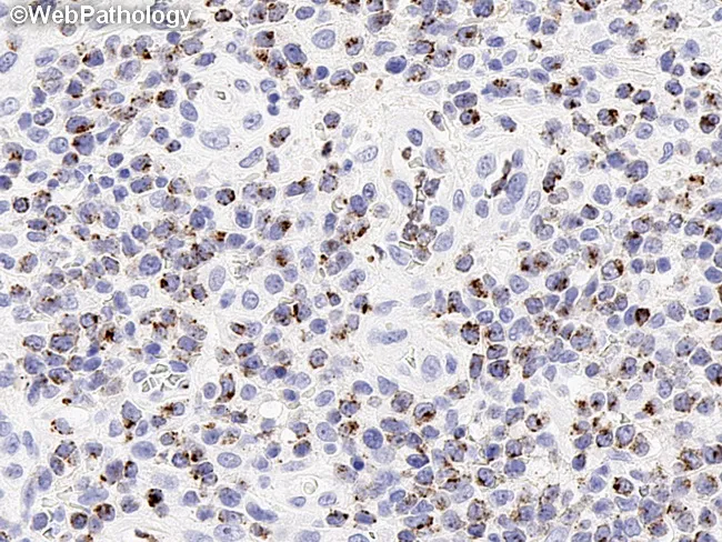 MEITL : Immunophenotype - TIA1