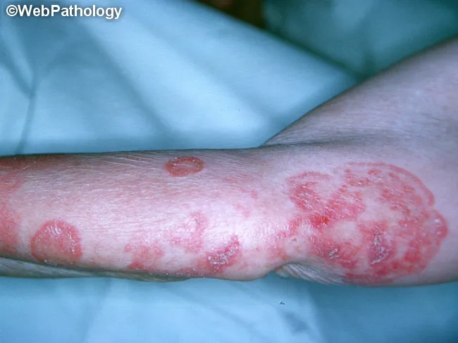 Mycosis Fungoides : Plaque Stage