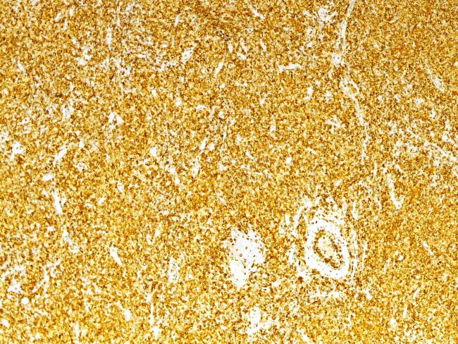 PTCL : Immuno-phenotype - CD4