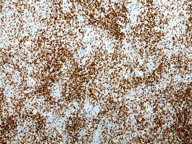 PTCL : Immuno-phenotype - CD7