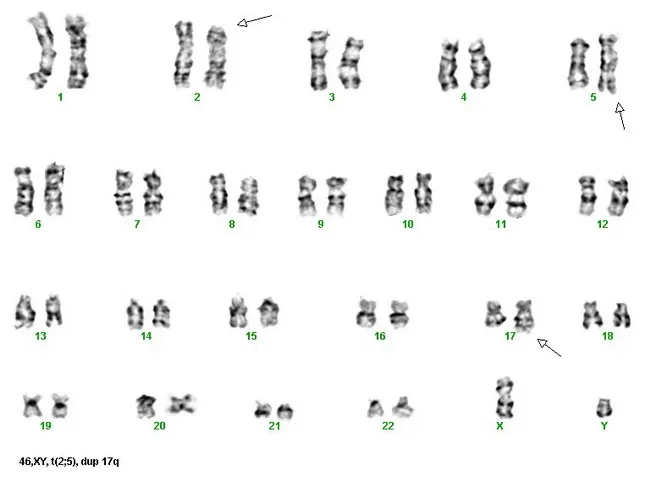 ALCL : t(2;5) translocation