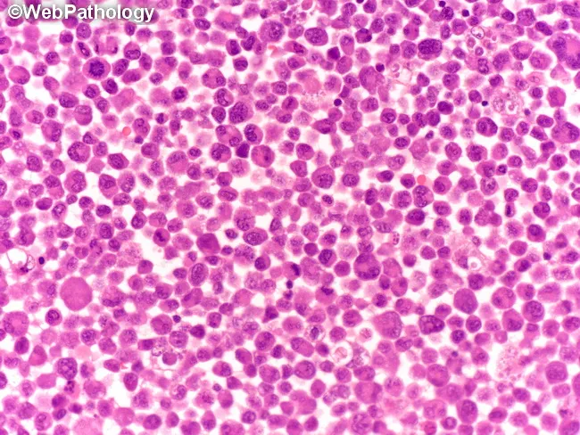 ALCL : ALK negative