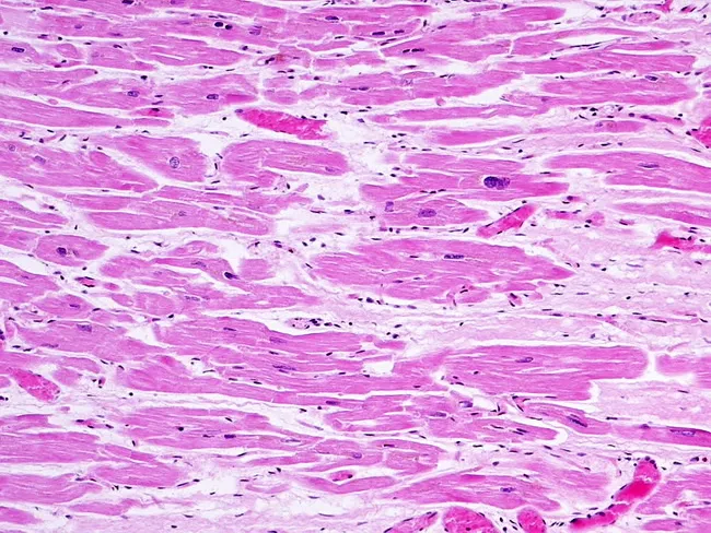 Dilated Cardiomyopathy