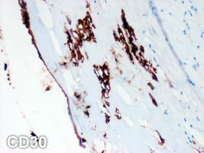 Breast Implant-associated ALCL : CD30