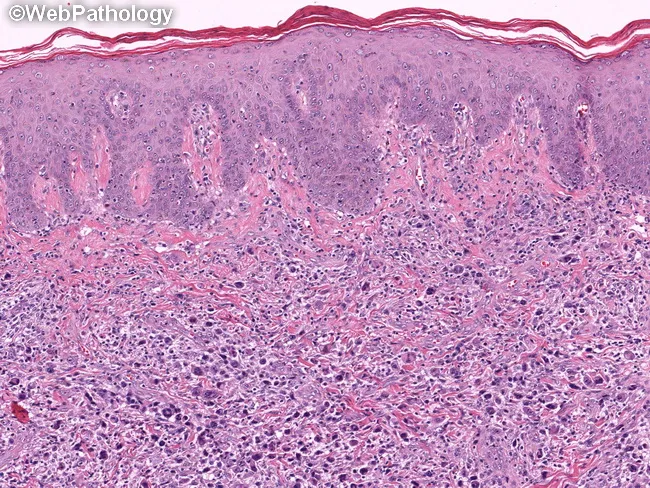 Primary Cutaneous ALCL