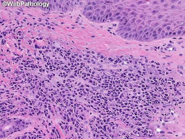 Primary Cutaneous ALCL