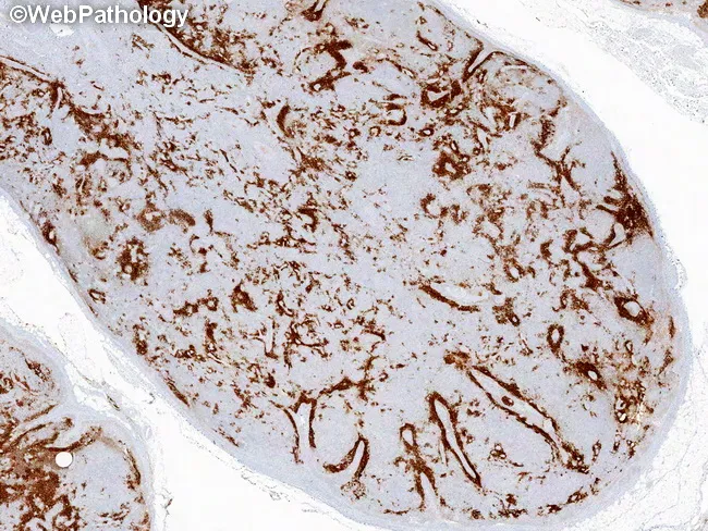 Follicular Dendritic Cell Networks in AITL : CD23