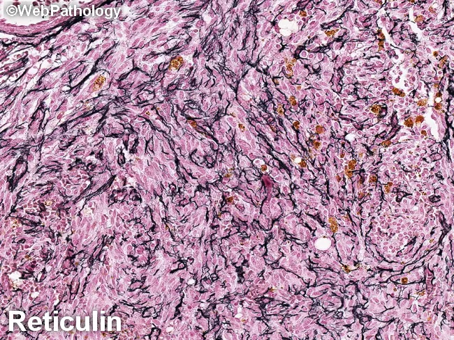 Systemic Mastocytosis : Bone Marrow - Reticulin
