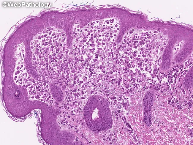 LCH : Treatment