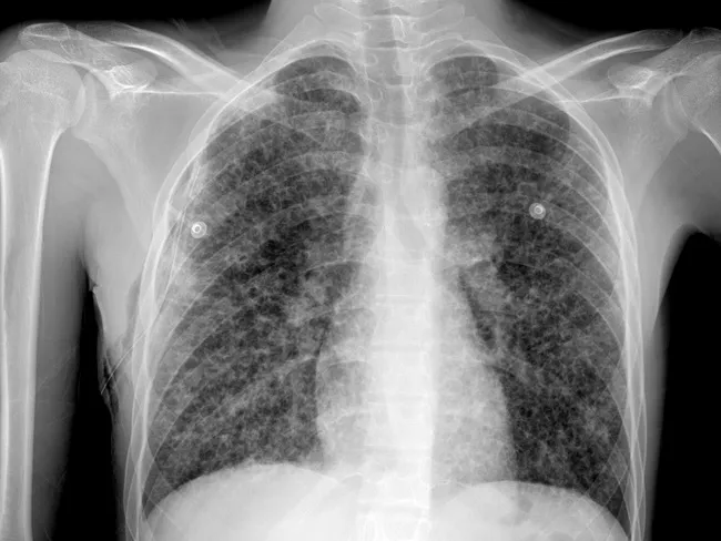 Pulmonary LCH : Clinical