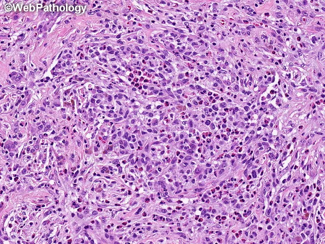 Pulmonary LCH : Morphology