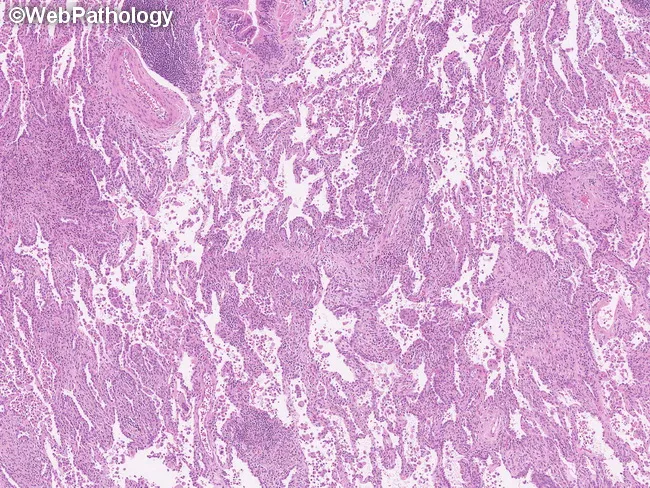 Pulmonary LCH : Molecular Features