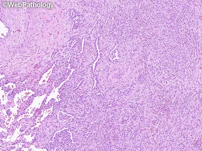 Pulmonary LCH : Treatment