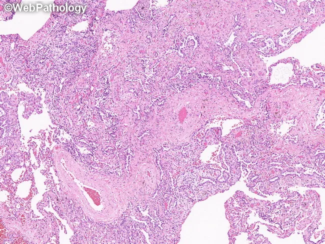 Pulmonary LCH