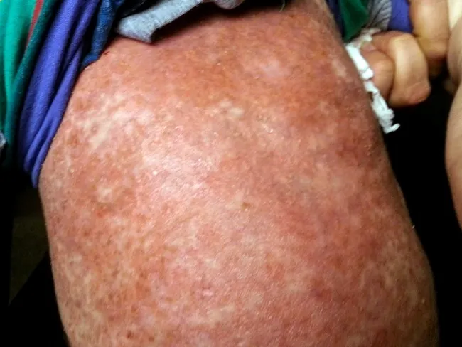 LCH of Skin