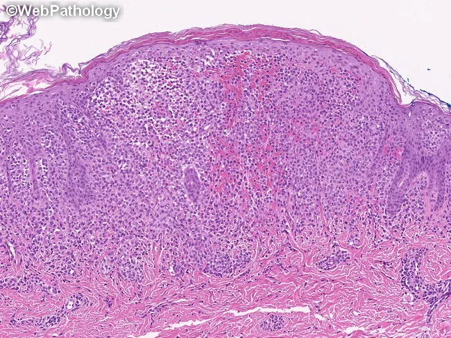 LCH of Skin : Morphology