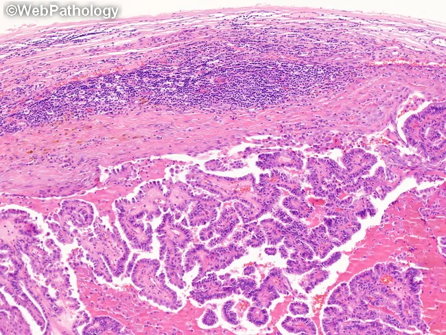 Metastatic Papillary Thyroid Carcinoma