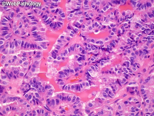 Metastatic Papillary Thyroid Carcinoma