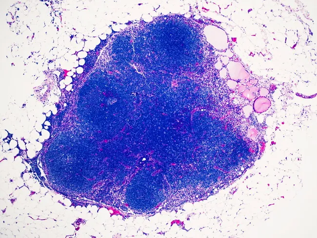 Thyroid Inclusions in Cervical Nodes