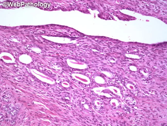 Mesonephric Duct Remnants