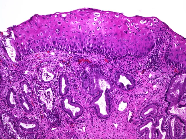 Flat Condyloma