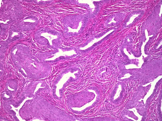Adenosquamous Carcinoma of Cervix