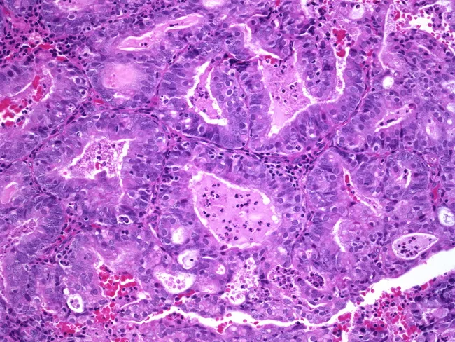 Endometrioid Adenocarcinoma, FIGO Grade 1