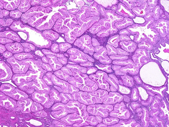 Endometrioid Adenocarcinoma, FIGO Grade 1