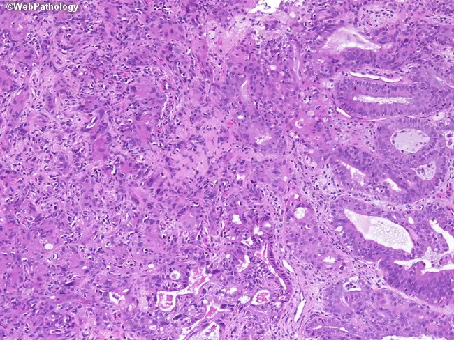 Endometrioid Adenocarcinoma, FIGO Grade 3