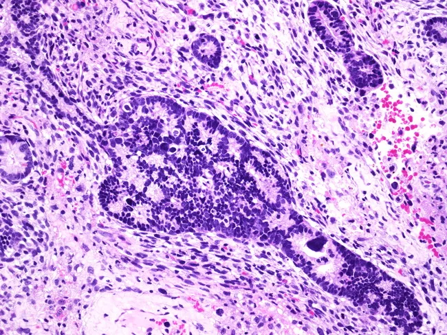 Malignant Mixed Mullerian Tumor (Carcinosarcoma)
