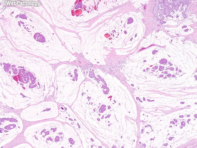 Mucinous Carcinoma of Breast