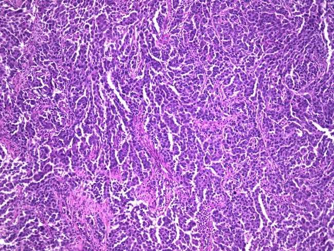 Serous Carcinoma of Fallopian Tube
