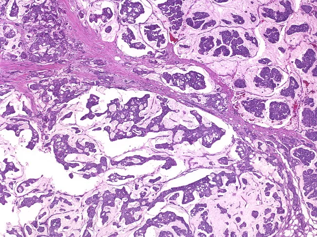 Mucinous Carcinoma of Breast
